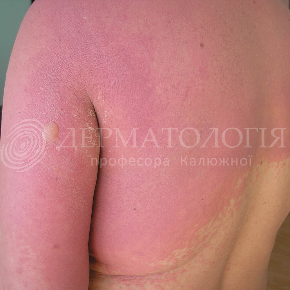 alergicheskiy-dermatit