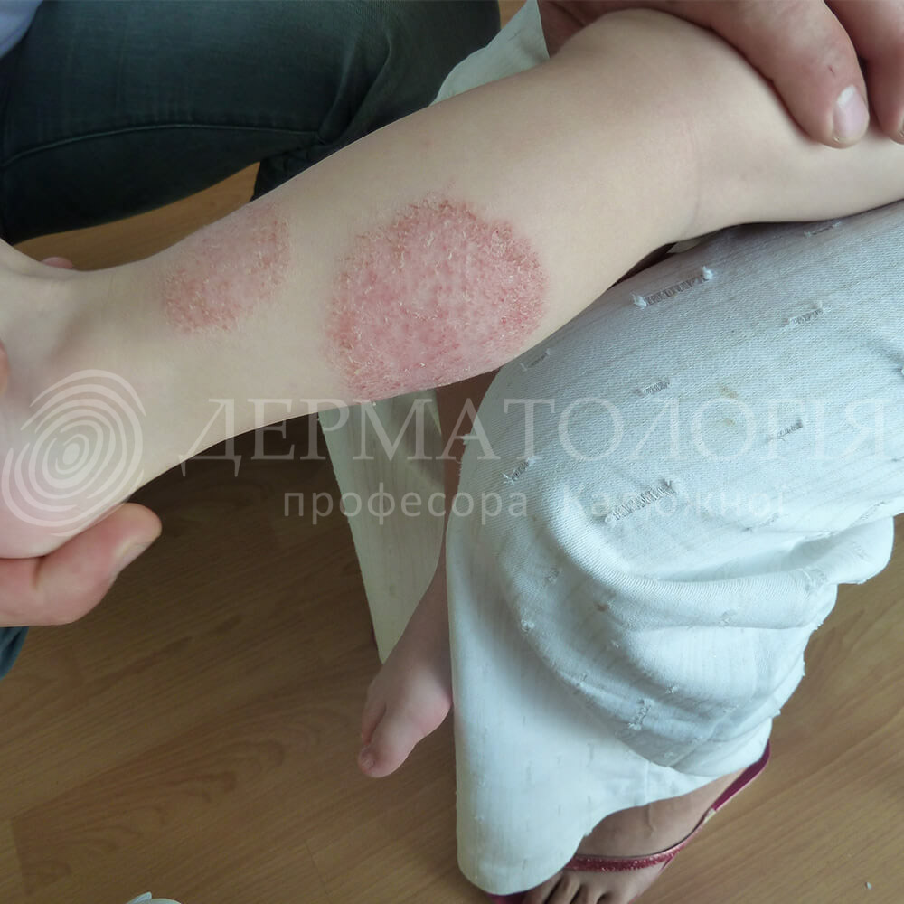 Атопический дерматит у детей и взрослых