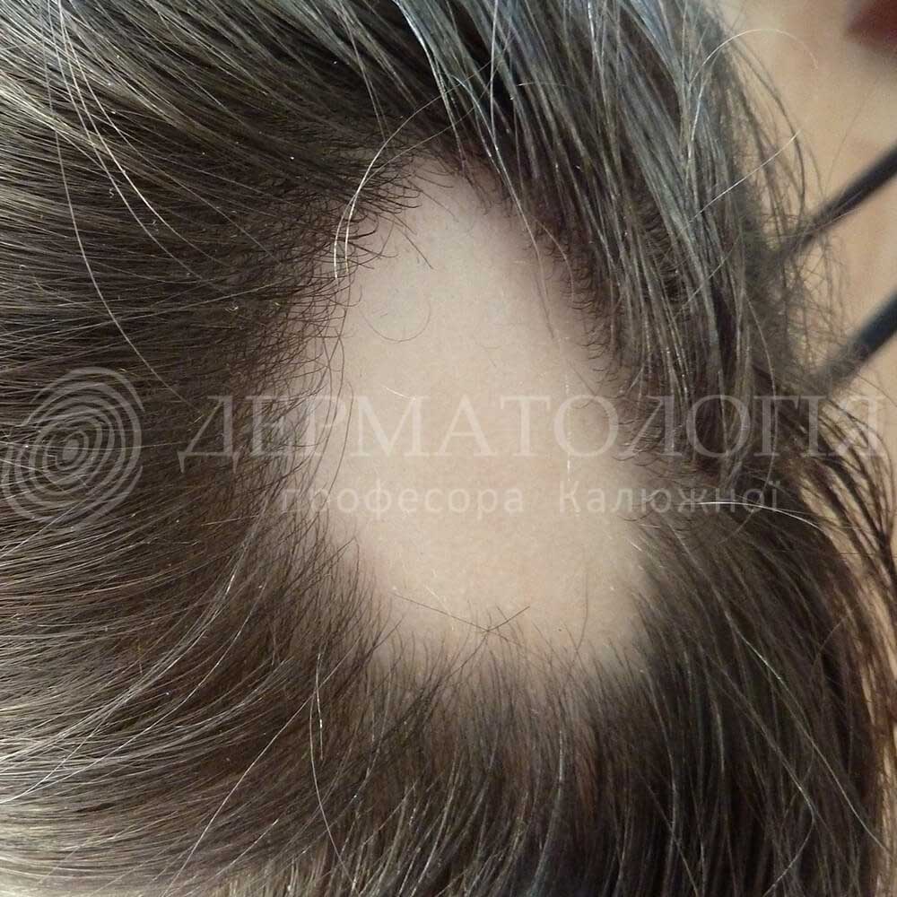 ochagovaya-alopeciya