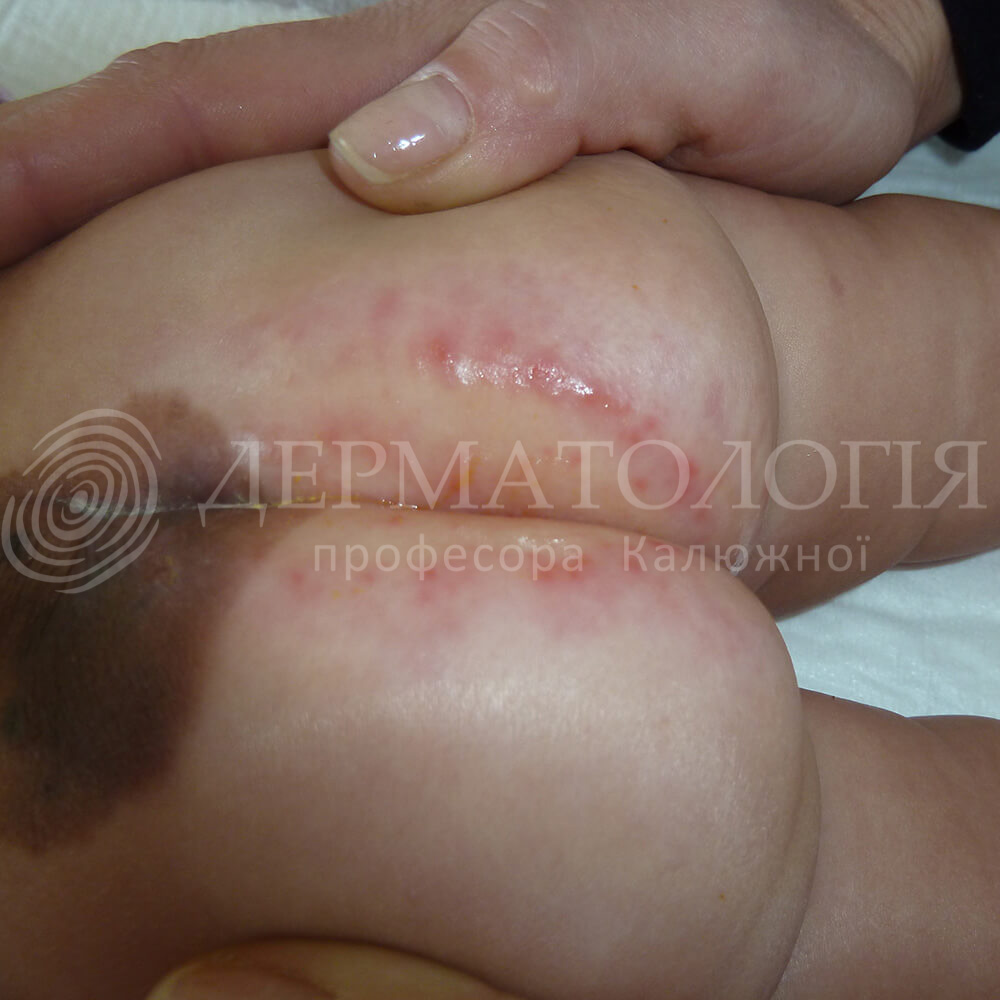 Атопический дерматит у младенцев