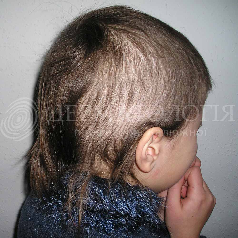 Ребенок вырывает волосы на голове