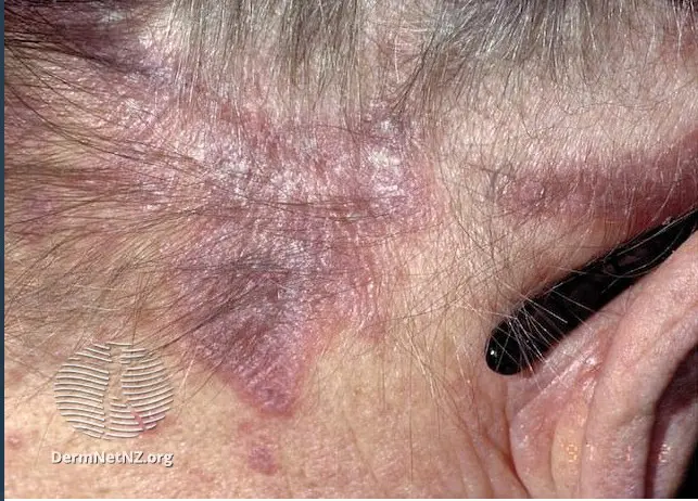 Фолликулярный кератоз: причины, симптомы и лечение «гусиной кожи»