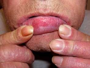 Красный плоский лишай во рту: так ли безобидно это заболевание и как его лечить