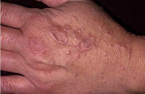 Типичные поражения кожи при кольцевидной гранулеме