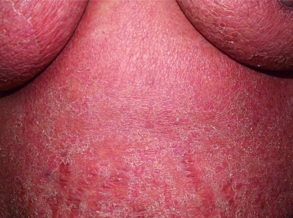 эритродермия с диффузной эритемой и шелушением кожи