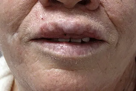 Что за белые точки на губах? Это опасно?