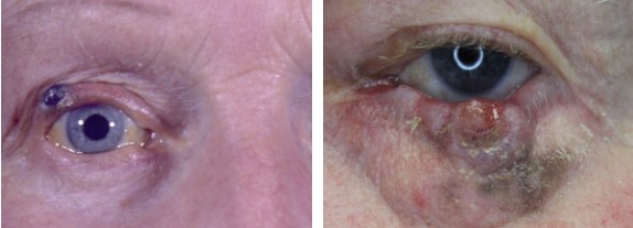 Окулярная (глазная) меланома