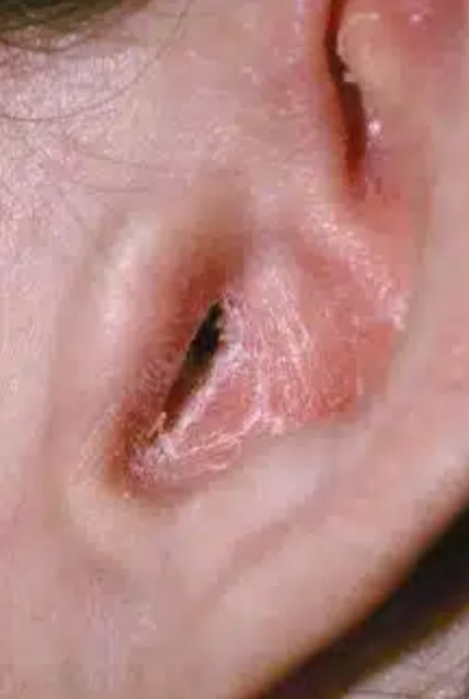 Псориаз кожи ушной раковины