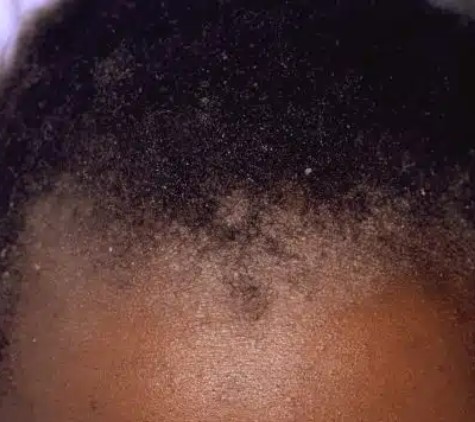 Псориаз волосистой части головы у темнокожего пациента