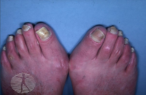 Синдром желтых ногтей